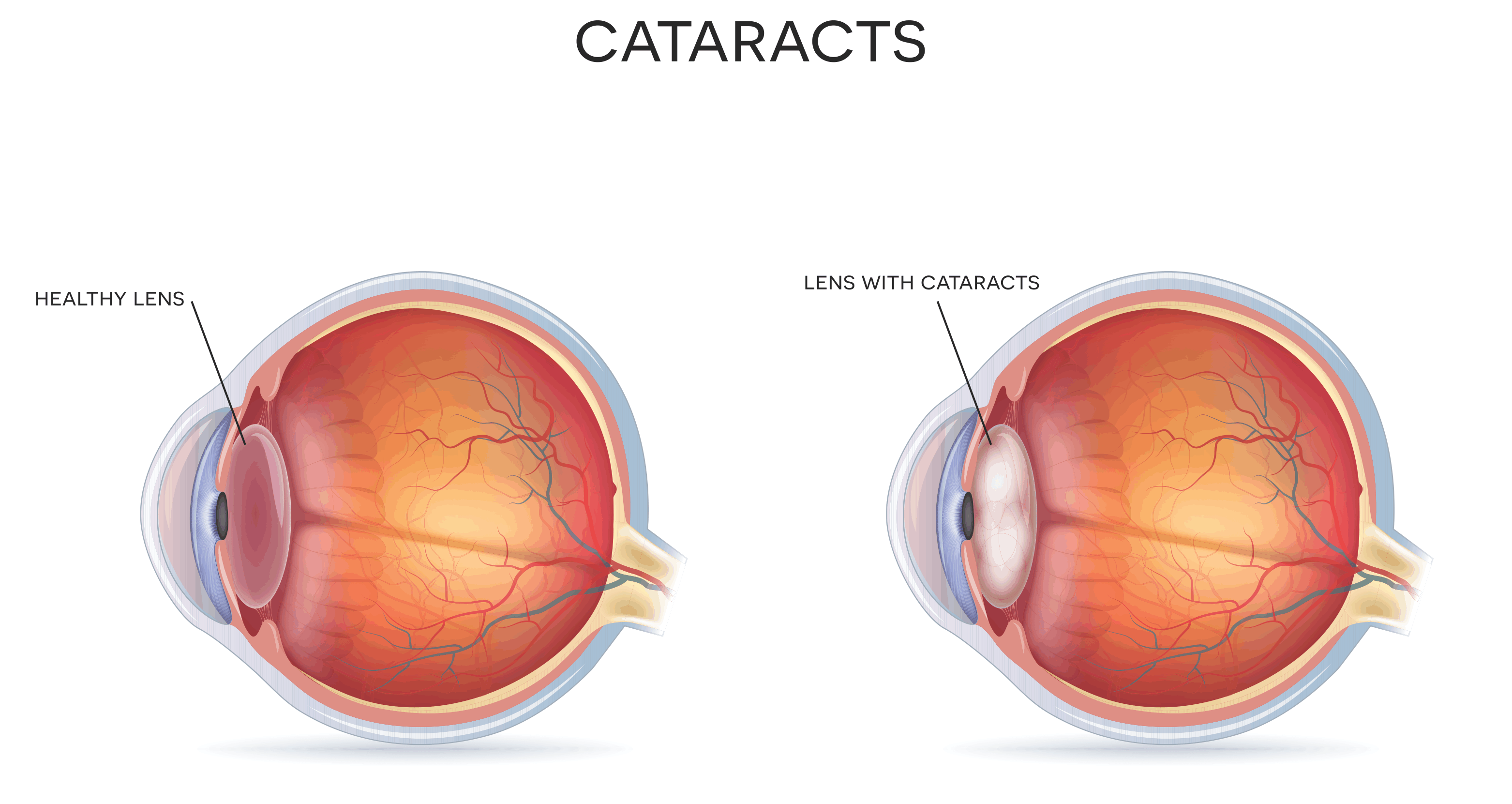 Eyes that are aging 2