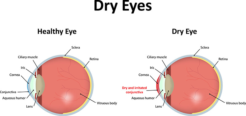 Eyes that are aging 4